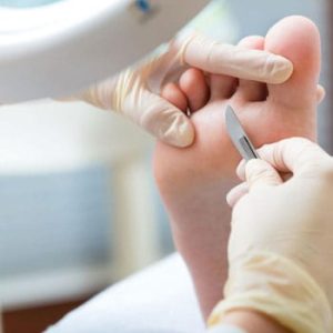 Curso de Verruga Plantar (VPH)